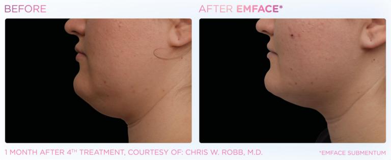 Emface_PIC_Ba-card-female-submentum-121_ENUS101